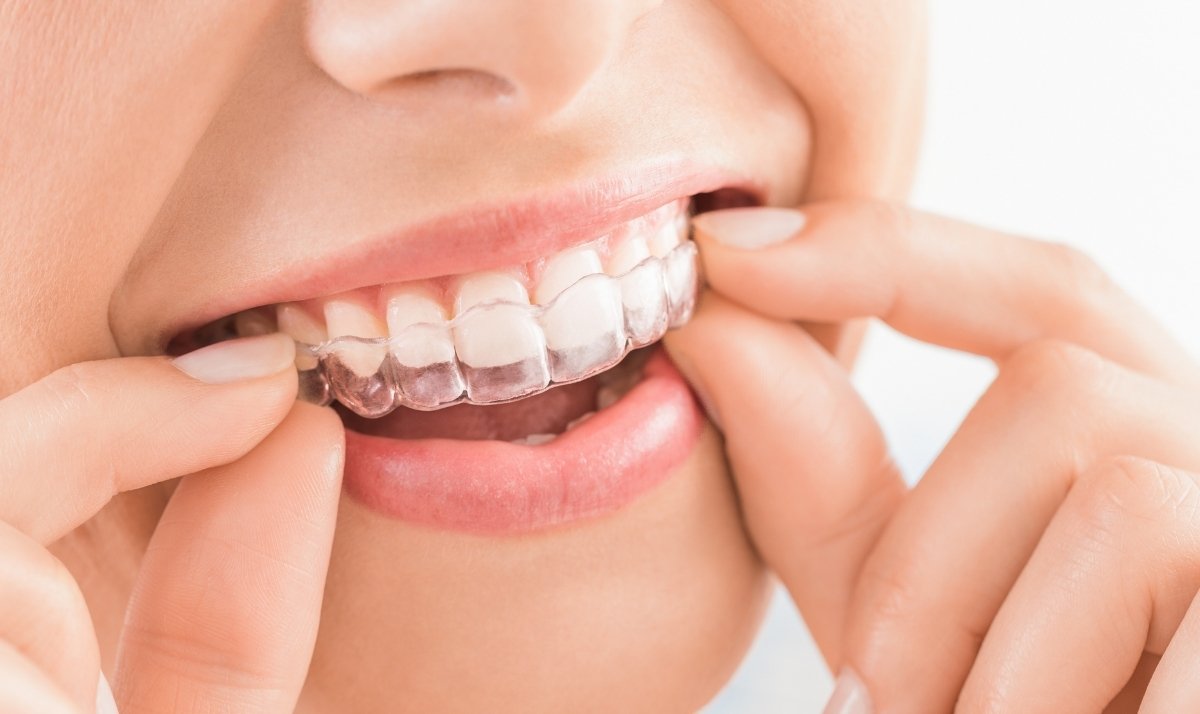 how invisalign works for all ages