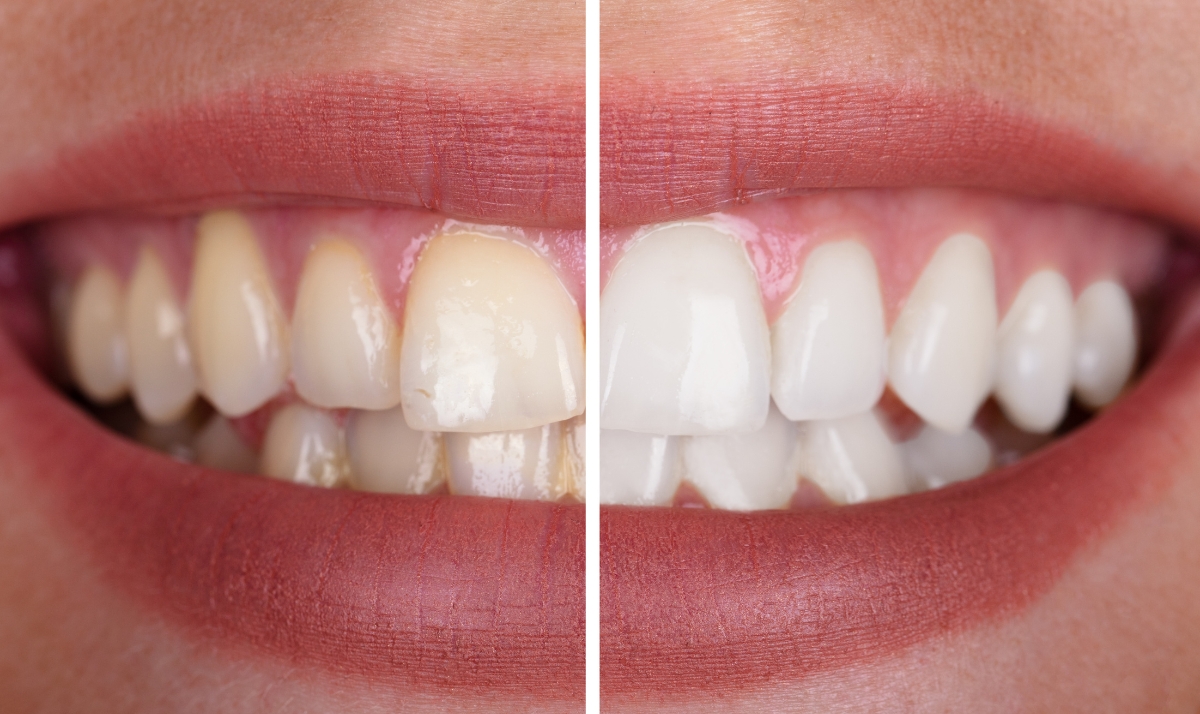 how kor whitening mitigates 6 problems with average whitening products