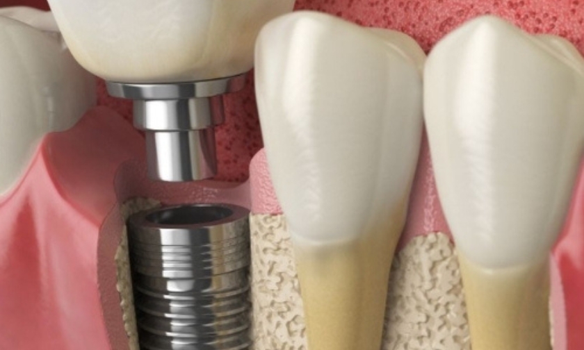 facial structure with dental implants